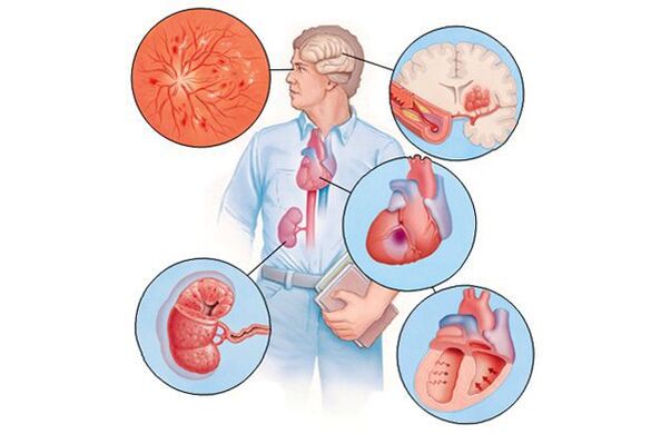 Poškodba različnih organov s dolgotrajno arterijsko hipertenzijo